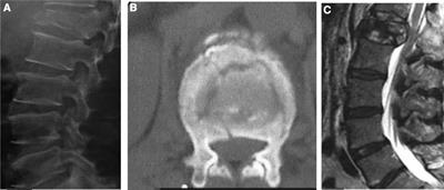 Reliability and repeatability of a modified thoracolumbar spine injury classification scoring system